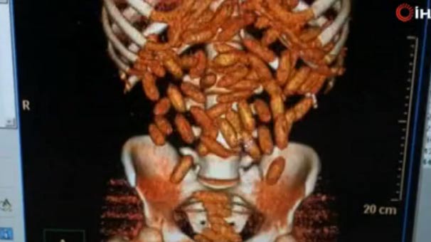 AHL’DE YAKALANDI, MİDESİNDEN ÇKARDILAR…